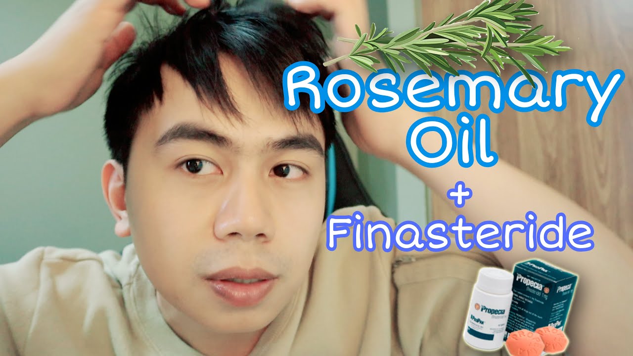 ROSEMARY OIL with FINASTERIDE for HAIR LOSS | My experience..