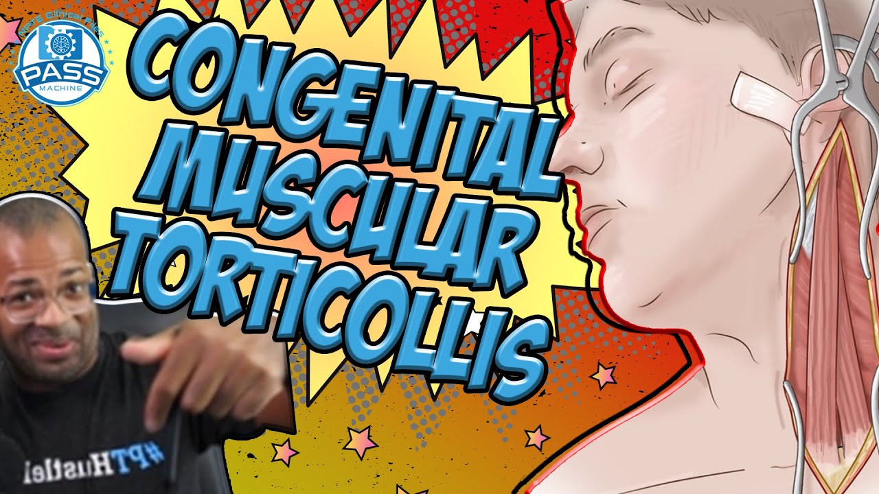NPTE Practice Questions: Congenital Muscular Torticollis