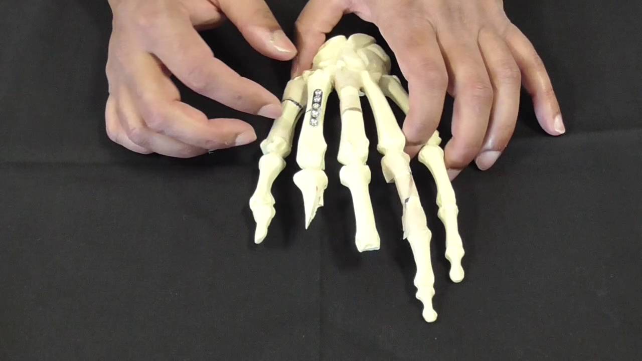 MEDICINE in a Nutshell: Hand Fracture Fixation Set