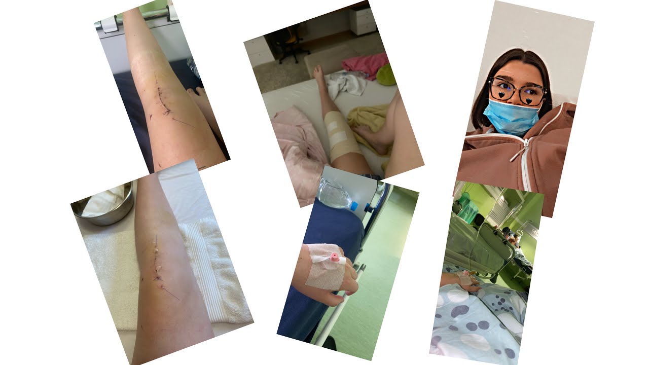 Operacija prednjih ukrštenih ligamenata