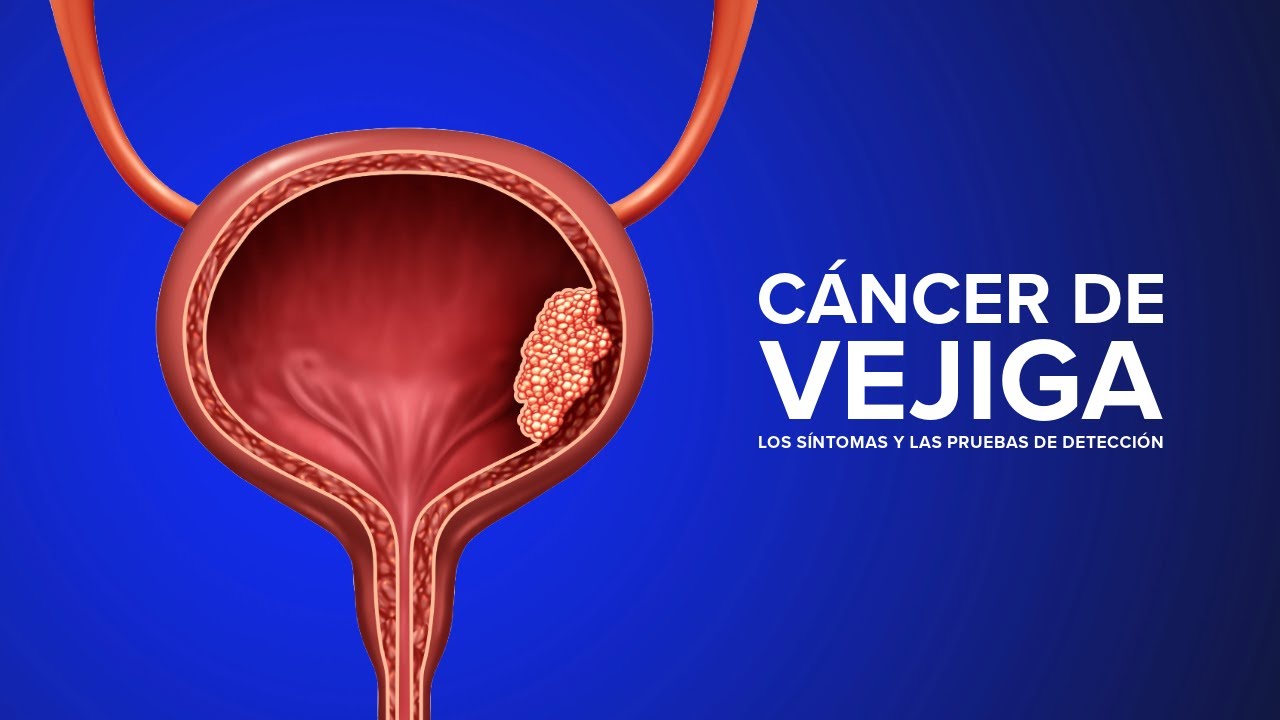 C&aacute;ncer de vejiga - Los s&iacute;ntomas y las pruebas de detecci&oacute;n |  UC Davis Health