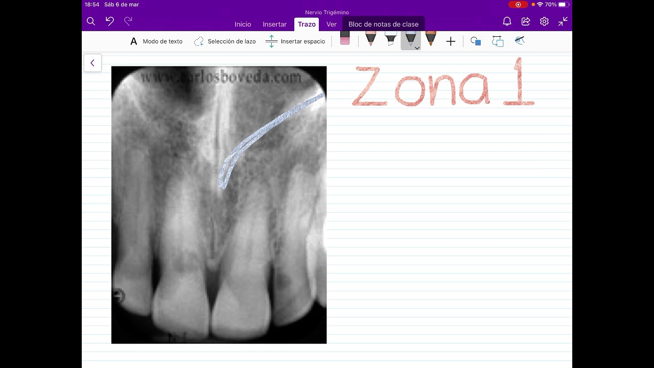 LO QUE SE VE EN UNA RADIOGRAF&Iacute;A DENTAL: Zona 1 de Incisivos Centrales Superiores