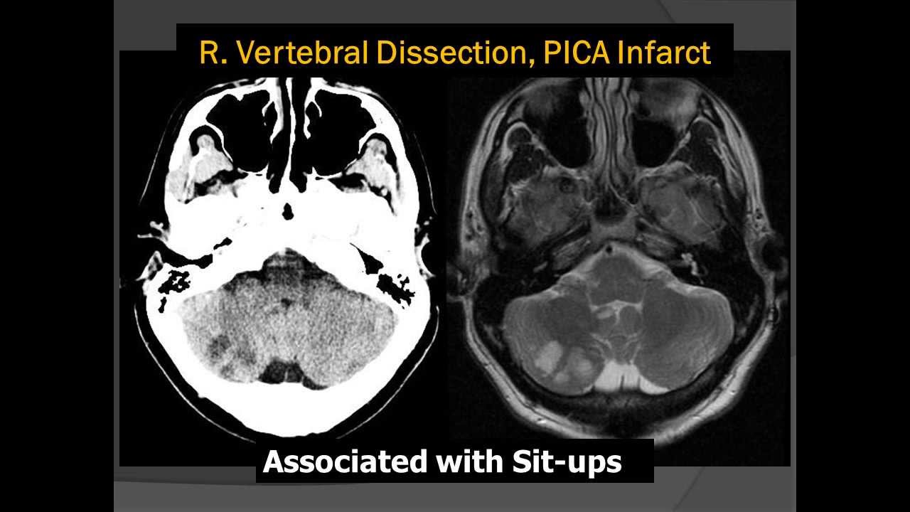 Situps Cause Stroke - Vertebral Artery Dissection with PICA Infarction