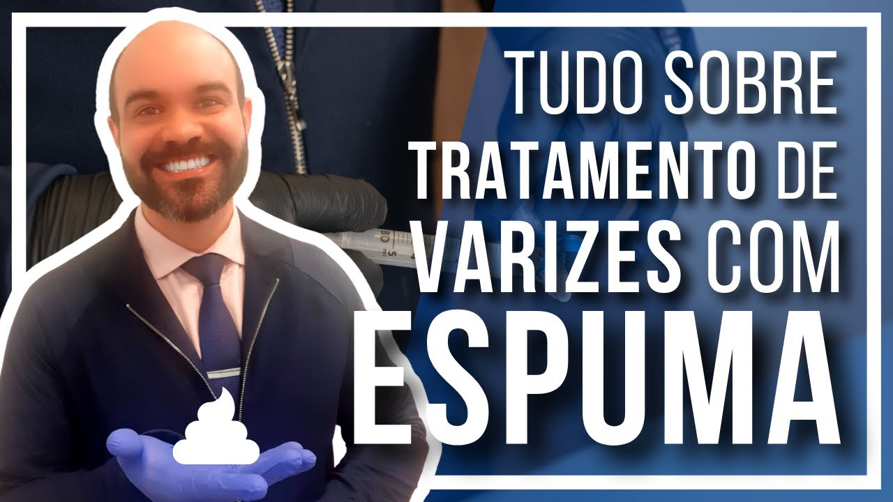 🔴Tudo sobre Tratamento de Varizes com ESPUMA [Varizes grossas sem Cirurgia]