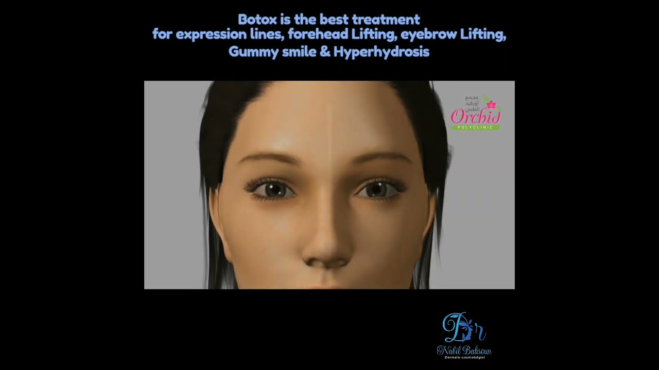 Botox by Dr Nabil Bahsoun