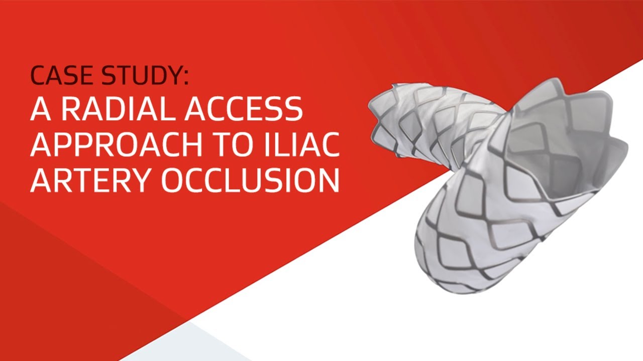 Case Study: A Radial Access Approach to Iliac Artery Occlusion