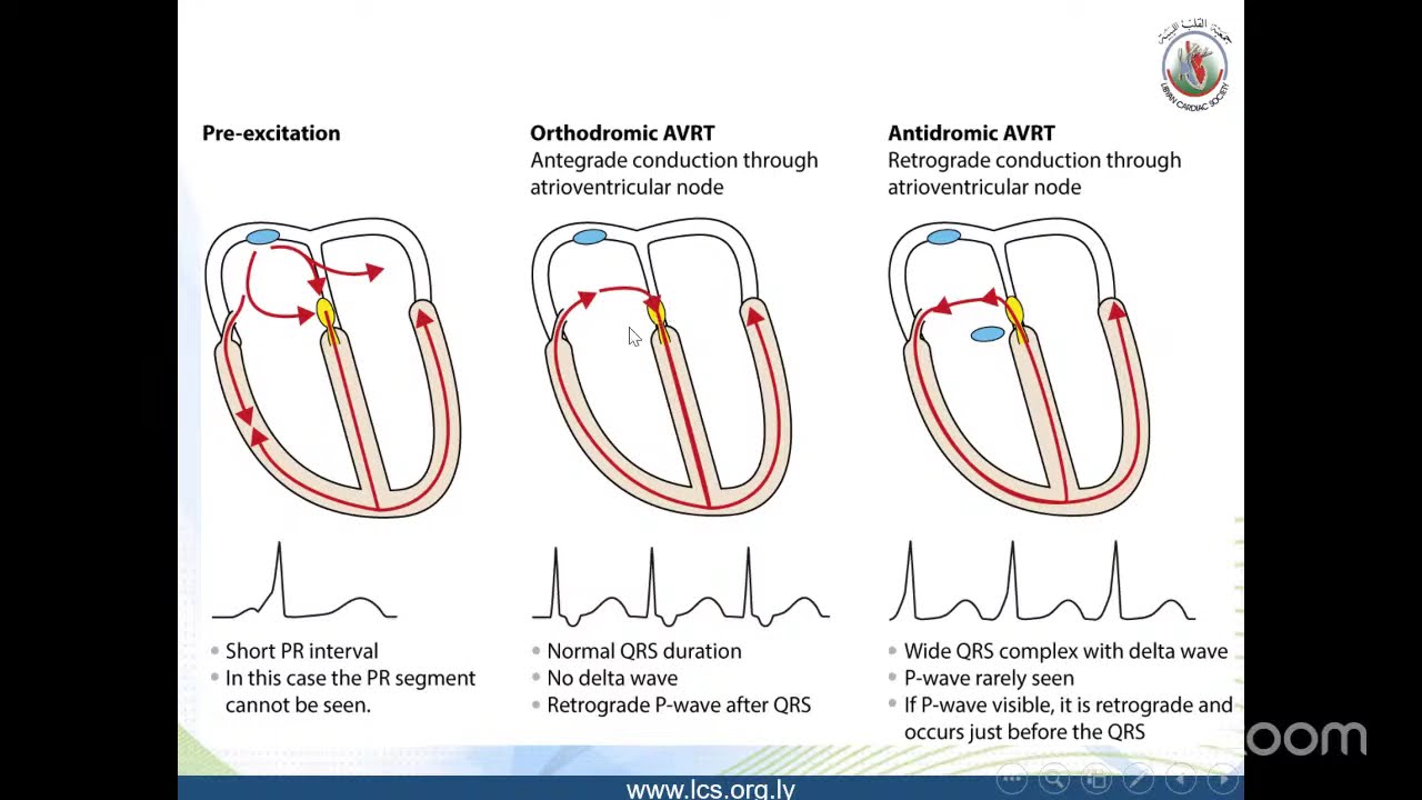 WPW is Ablation Requuired?