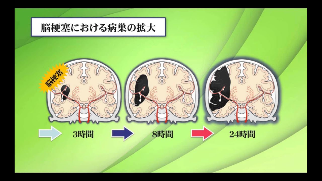 徳島大学病院「TVいきいきらいふ」第70回脳血管内治療