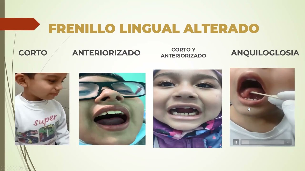 Frenillo lingual corto y cuándo operar