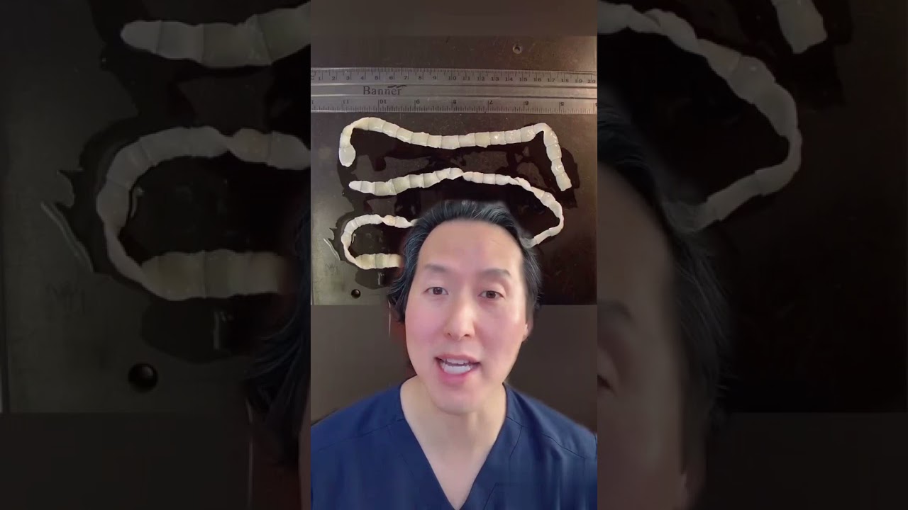 Weight Loss Due To Tapeworms?!?! It&rsquo;s True #shorts