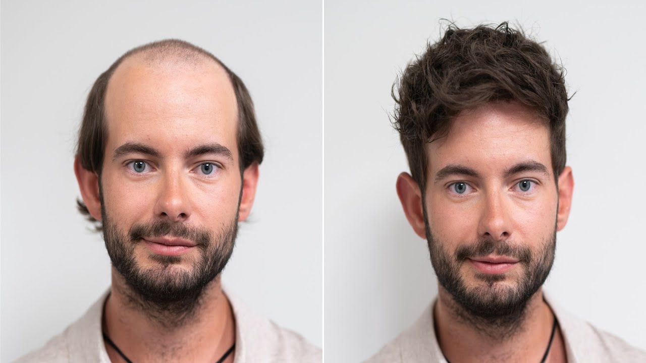 Hair loss solutions I Transformation with Hairsystem I Hairsystems Heydecke