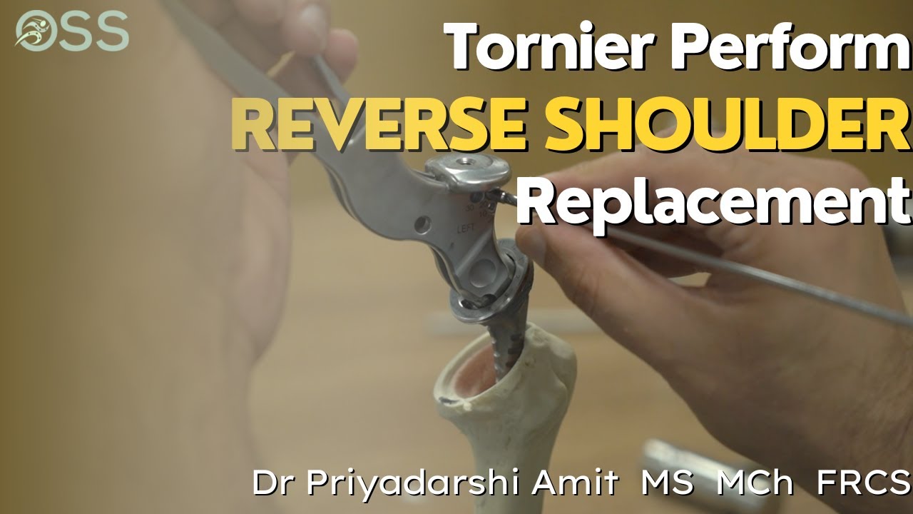 Tornier Perform Reverse Shoulder Replacement | Saw Bone - Surgical Technique | Dr Priyadarshi Amit
