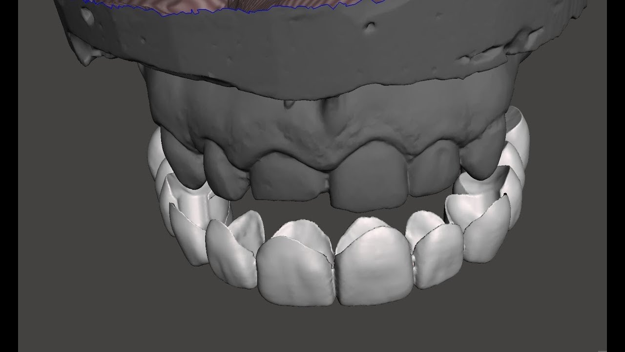 Digitally Creating Snap on Teeth that can be 3d Printed