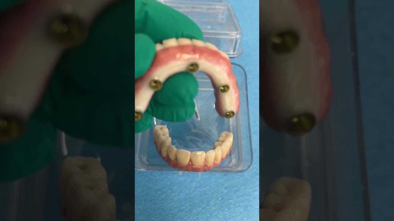 Dental Implant Full mouth Lab Work Pearls