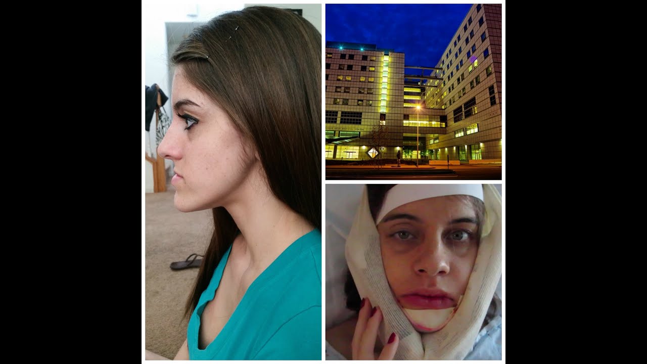 Jaw Surgery Journey #2 - Surgery Day