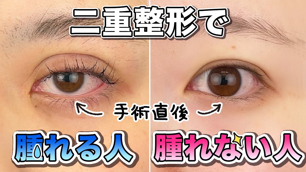 二重整形で腫れる人・腫れない人【埋没法・全切開】