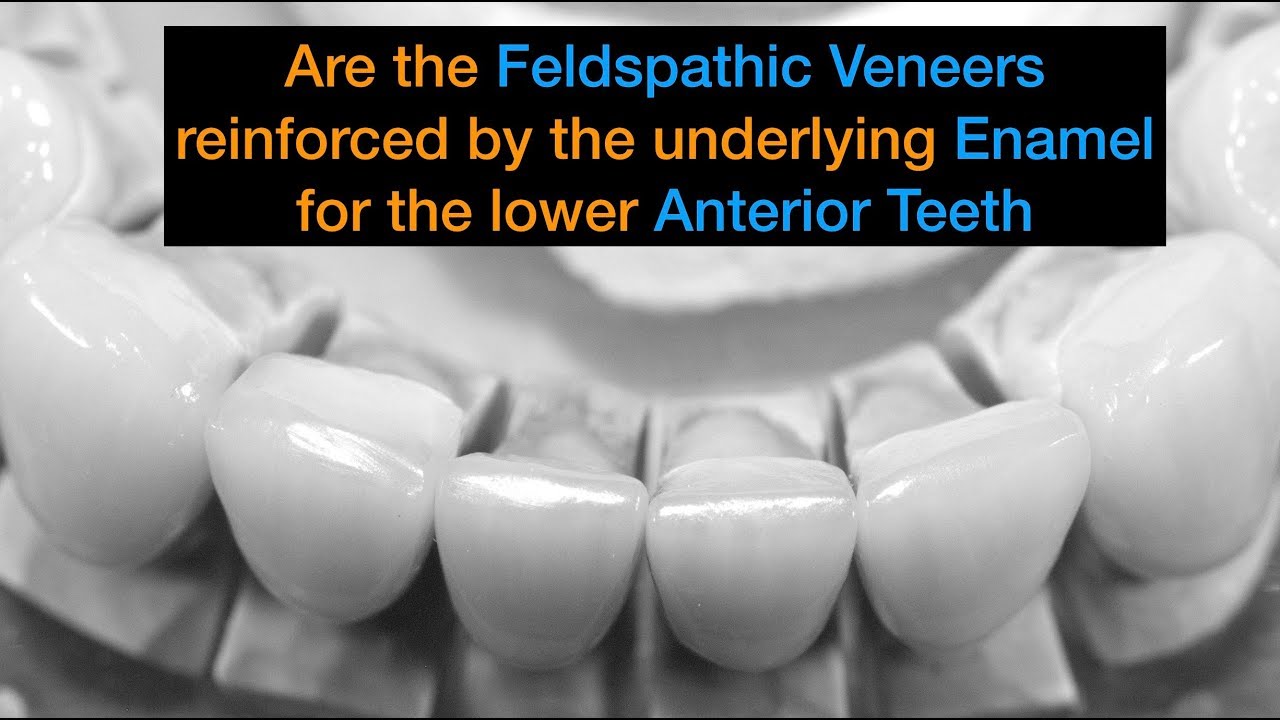 New Video- Are these veneers reinforced by enamel?
