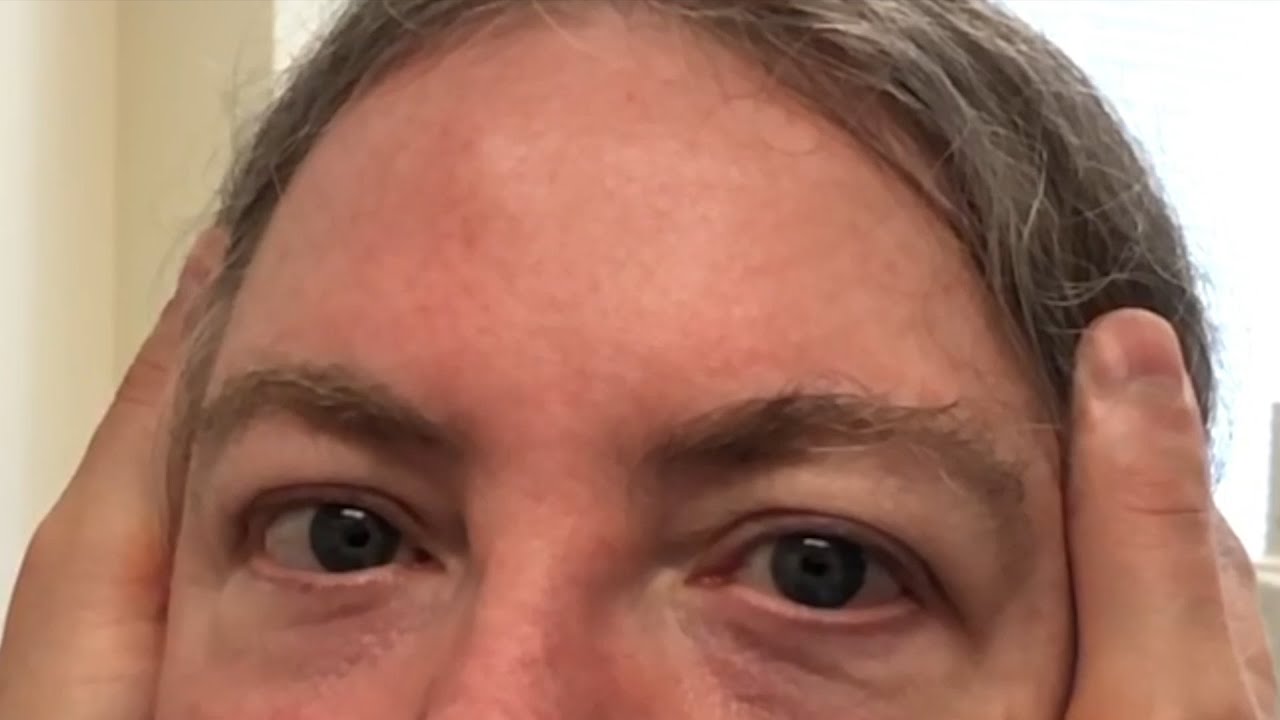 Rapid Eye Movement as a Sign of Vestibular Disease on Slow-Motion Video
