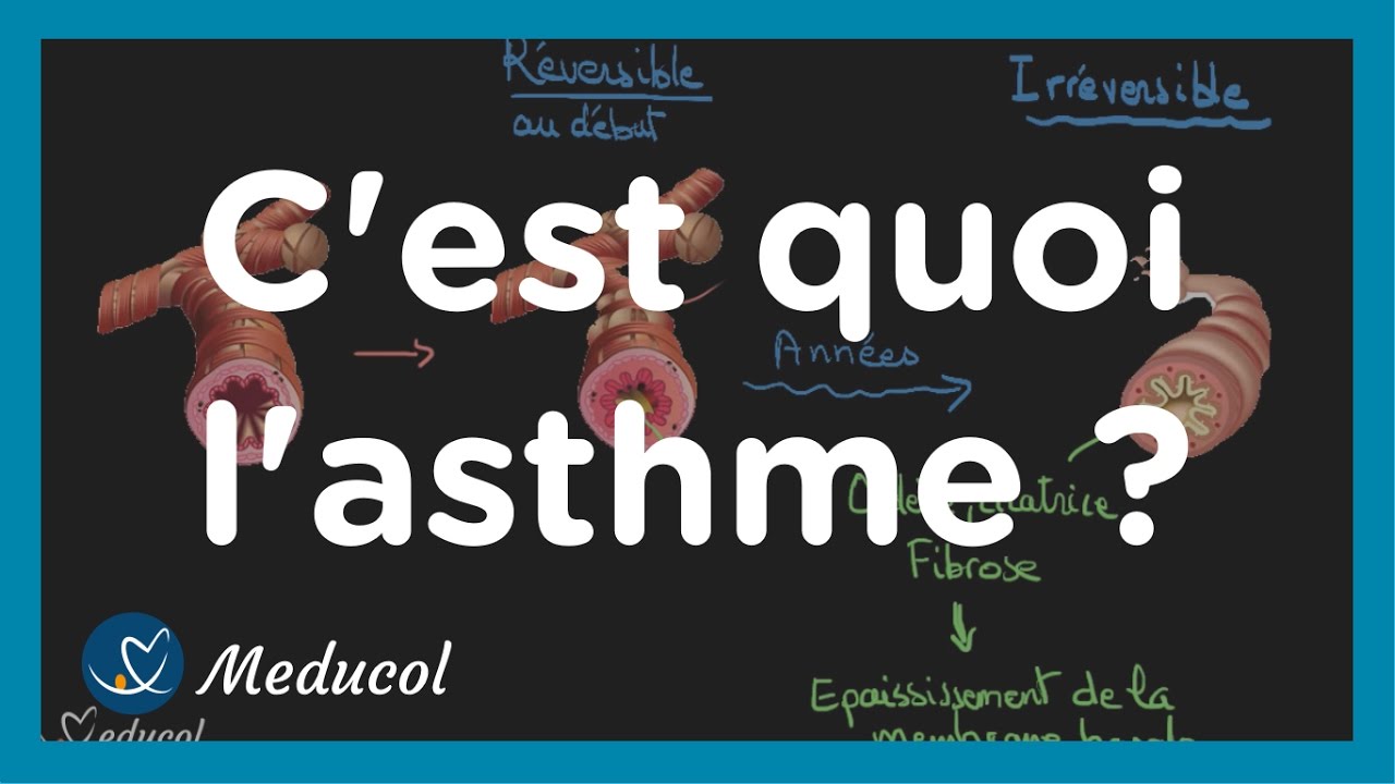 L'asthme c'est quoi: physiopathologie, causes, symptômes et traitement