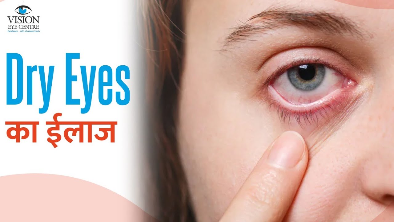 Dry Eyes : Causes, Syndrome & Treatment ( आंखों में सूखापन ) | Dry Eyes Treatment in Hindi