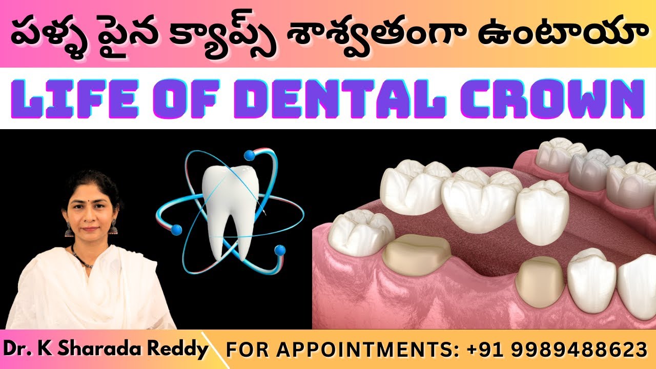 పళ్ళ పైన క్యాప్స్ శాశ్వతంగా ఉంటాయా LIFE OF DENTAL CROWN | by Dr. K Sharada in telugu #dentalcrowns