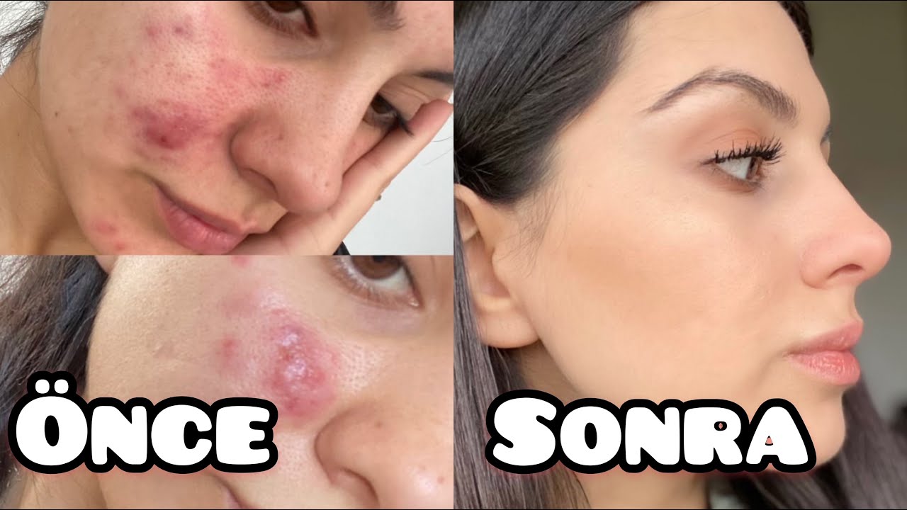 SİVİLCELERİMDEN NASIL KURTULDUM?roaccutane tedavisi,the ordinary ürünleri bütün sürecim🧐