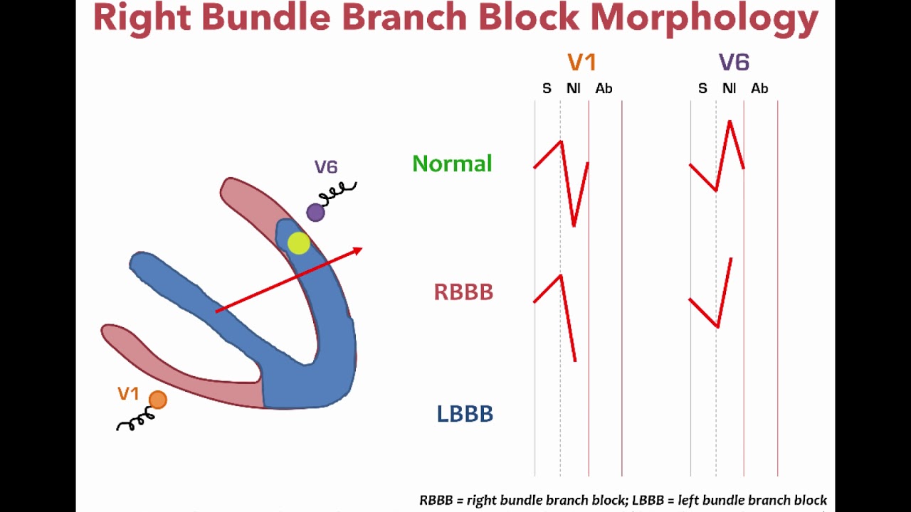 Left Bundle Branch Block and Right Bundle Bundle Branch Morphology