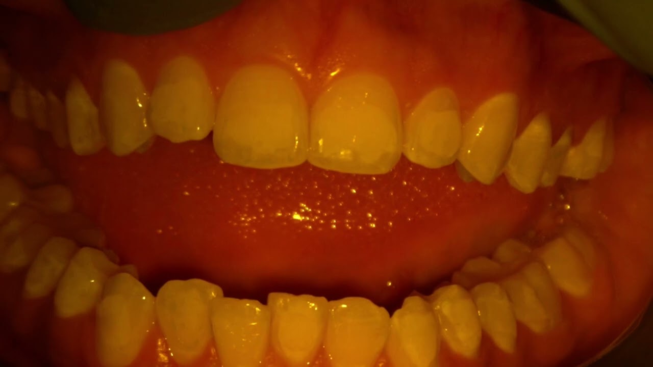 Aligner  attachment  bonding step by step 