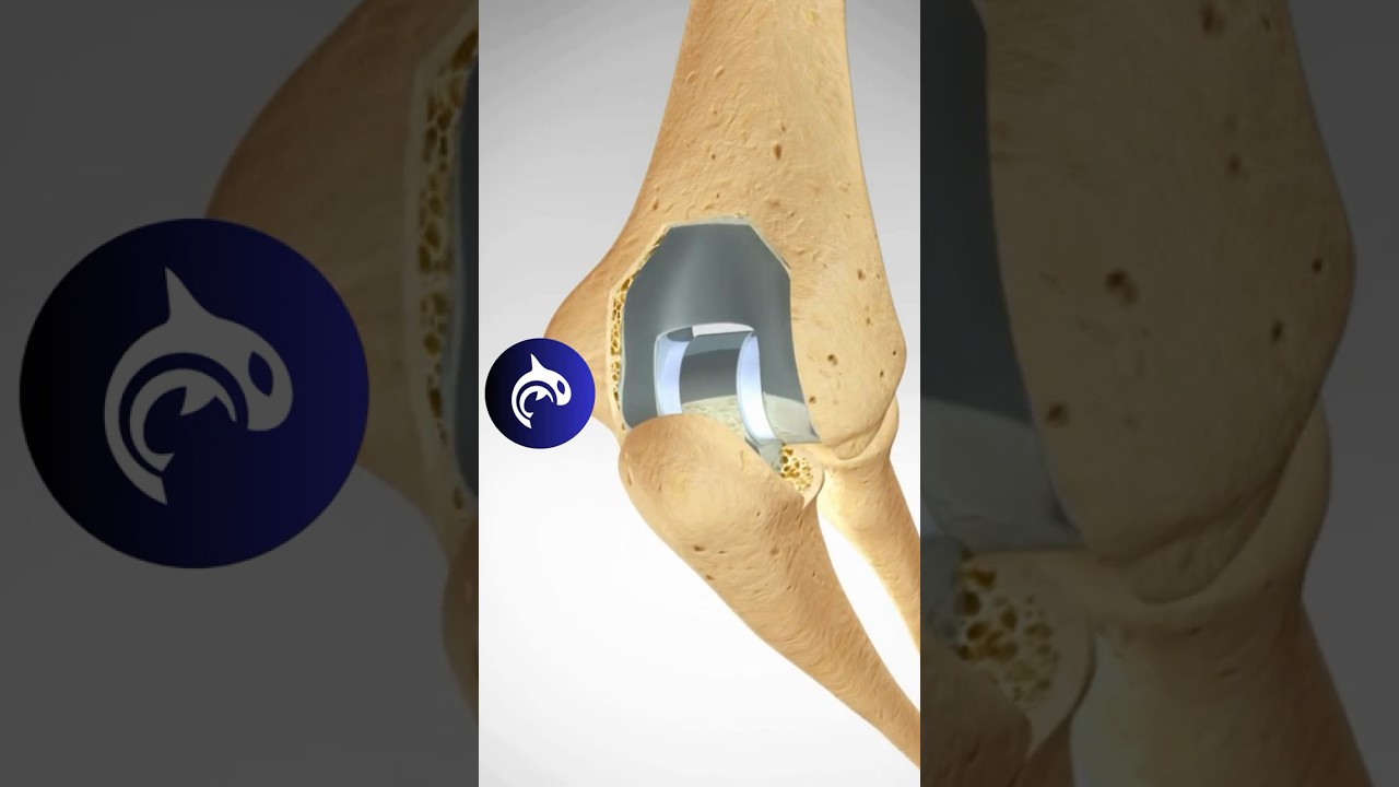 Total Elbow Replacement (TER) 