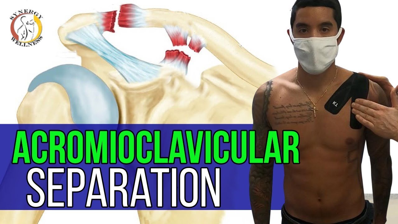 AC / AcromioClavicular Separation Kinesio Tape AC Joint