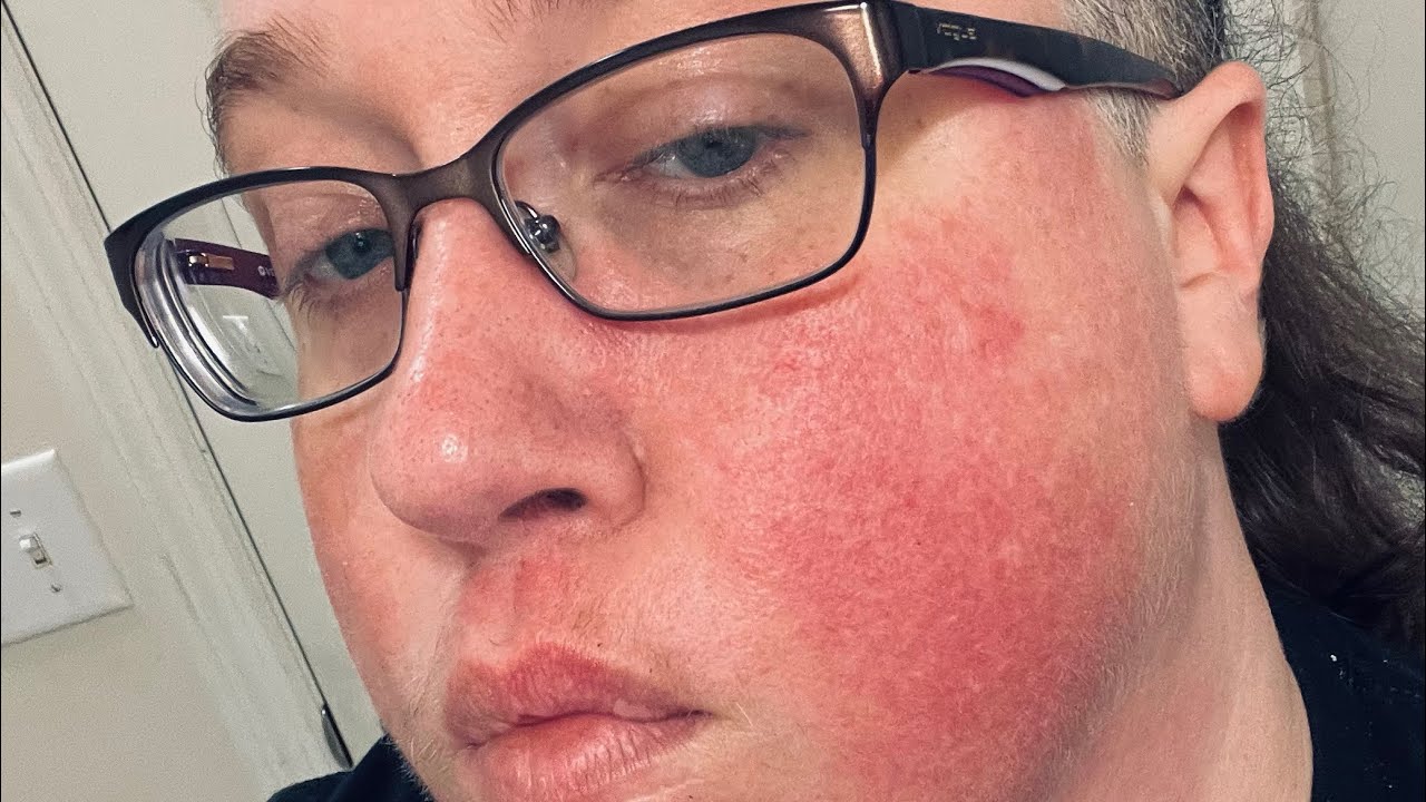 Video 2 - How it all started @Living on Fire: Erythromelalgia & Anhidrosis