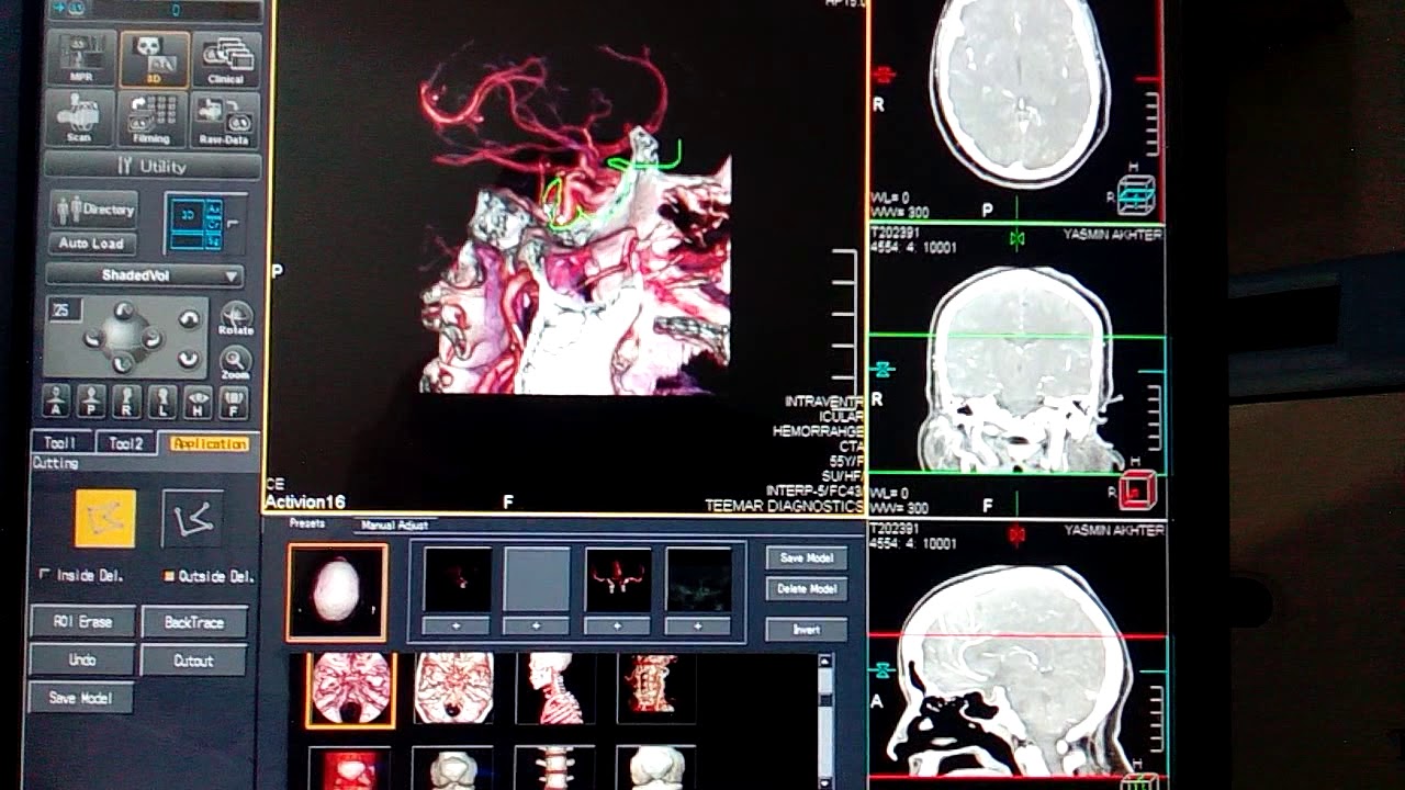 #CerebralAngiography #CTA #3DBrainAngio