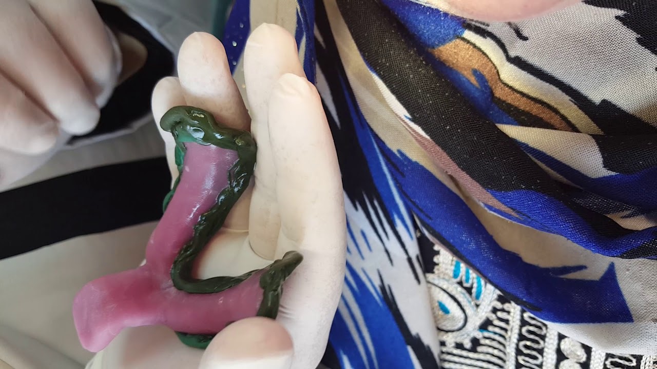 Visit 2: Lower special tray border moulding in the lingual sulcus: Errors and corrections