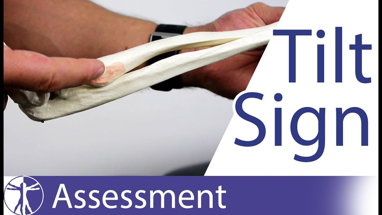 Tilt Sign | Partial Distal Biceps Tendon Rupture
