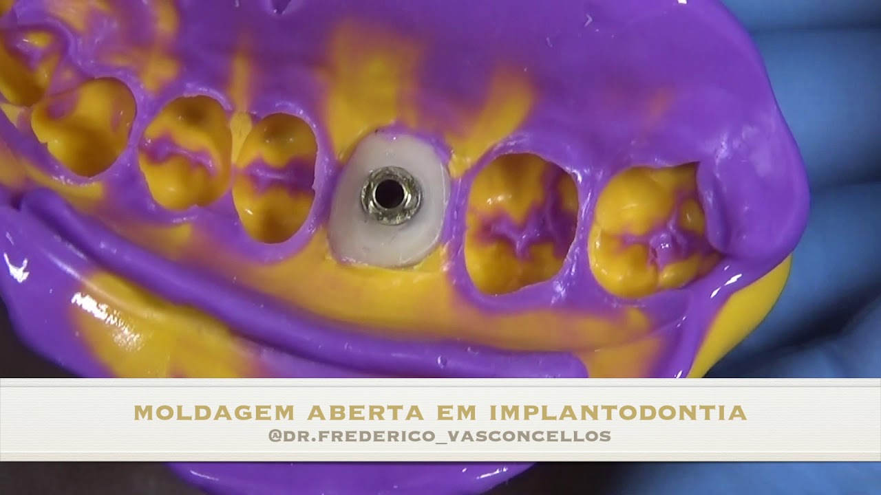 Moldagem de Implante: técnica da moldadeira aberta