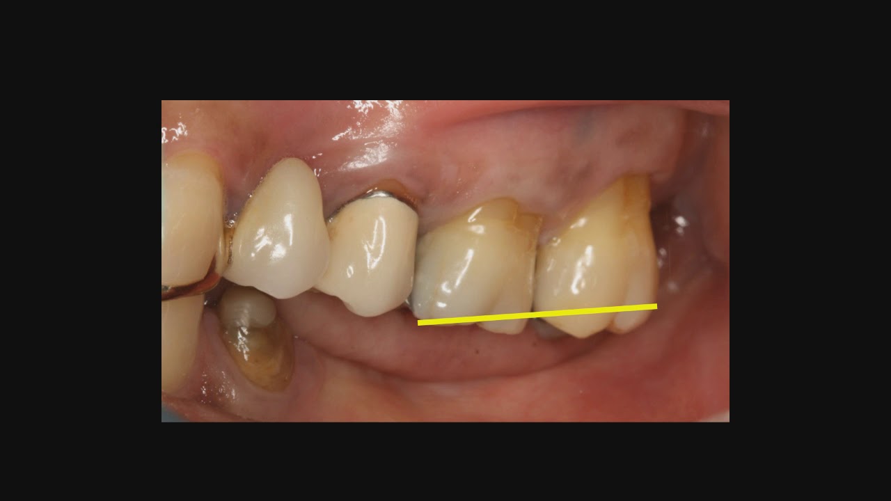 Lecture #19 &ndash; Enameloplasty