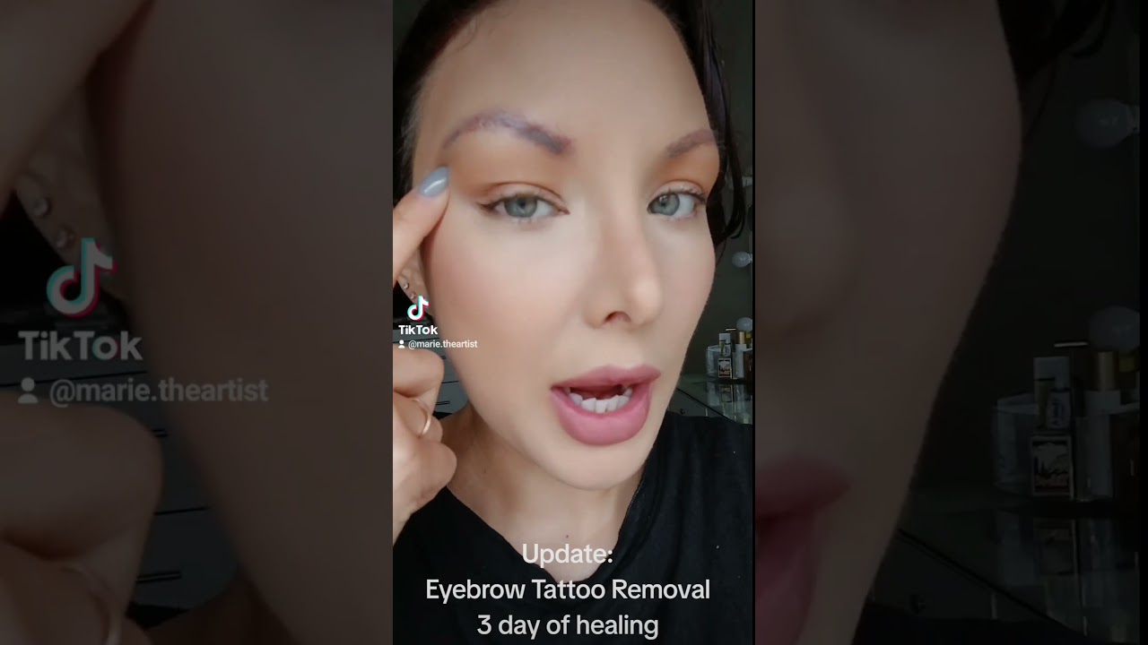 3 дня заживления после удаления татуировки бровей с помощью Pico Laser.@EvolvetattooremovalSanDiego