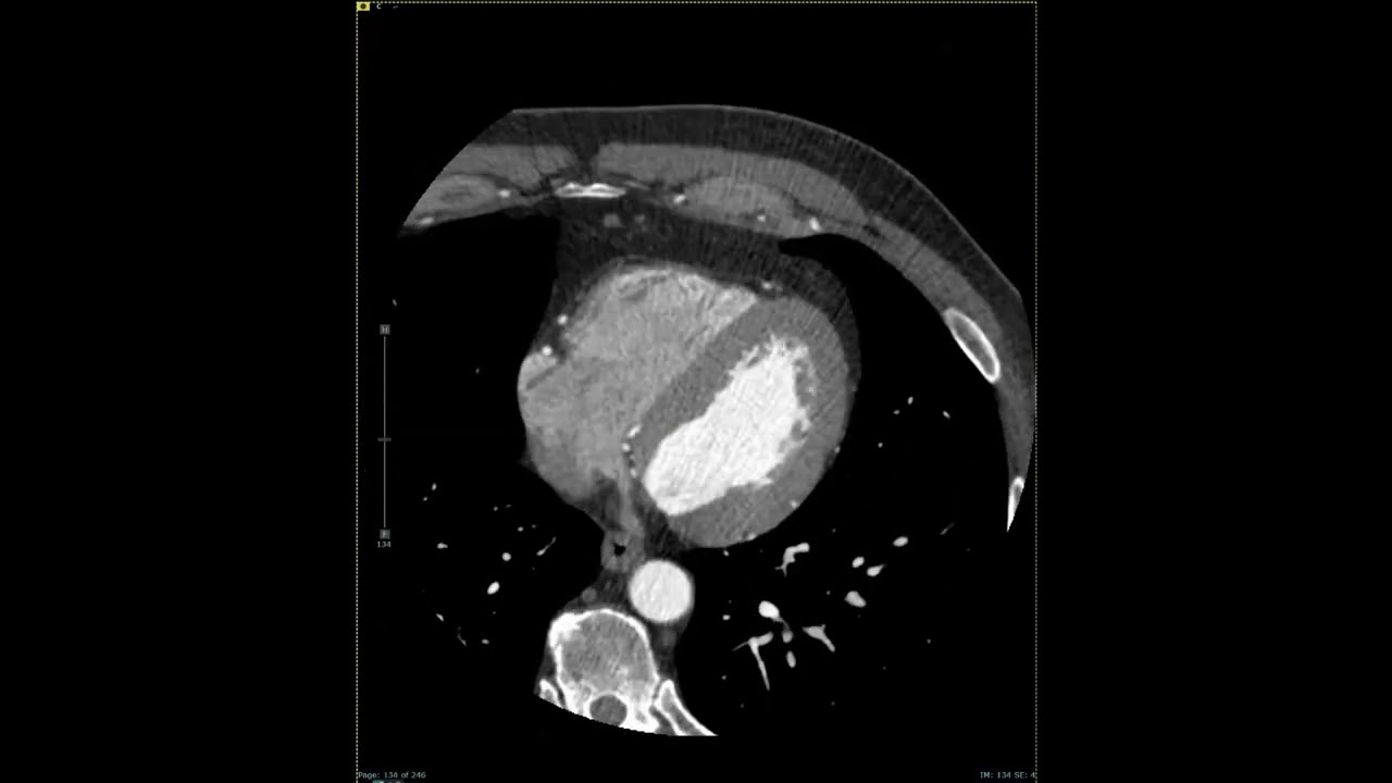 Looking Inside a CCTA with Dr. Hota at Atlantic Medical Imaging
