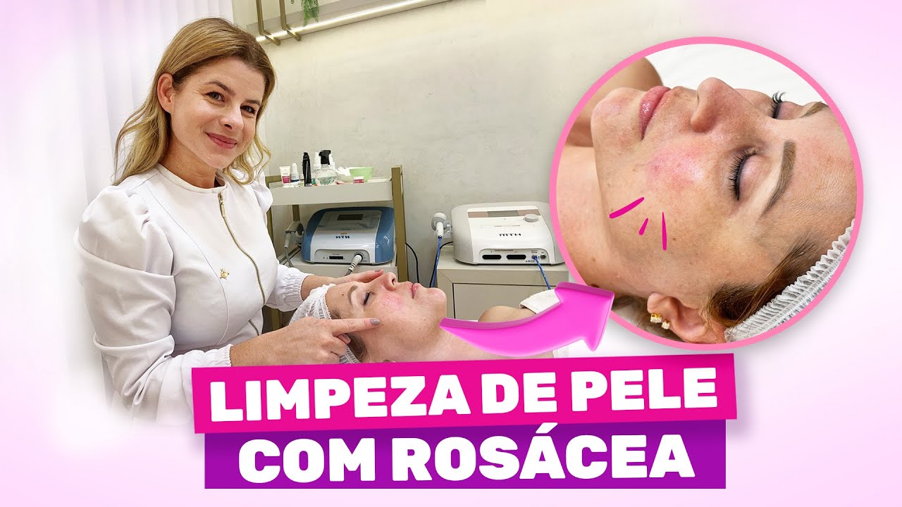 Limpeza de pele com rosácea - passo a passo