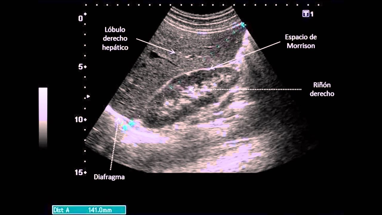 Vídeo 5  Corte longitudinal en línea axilar anterior