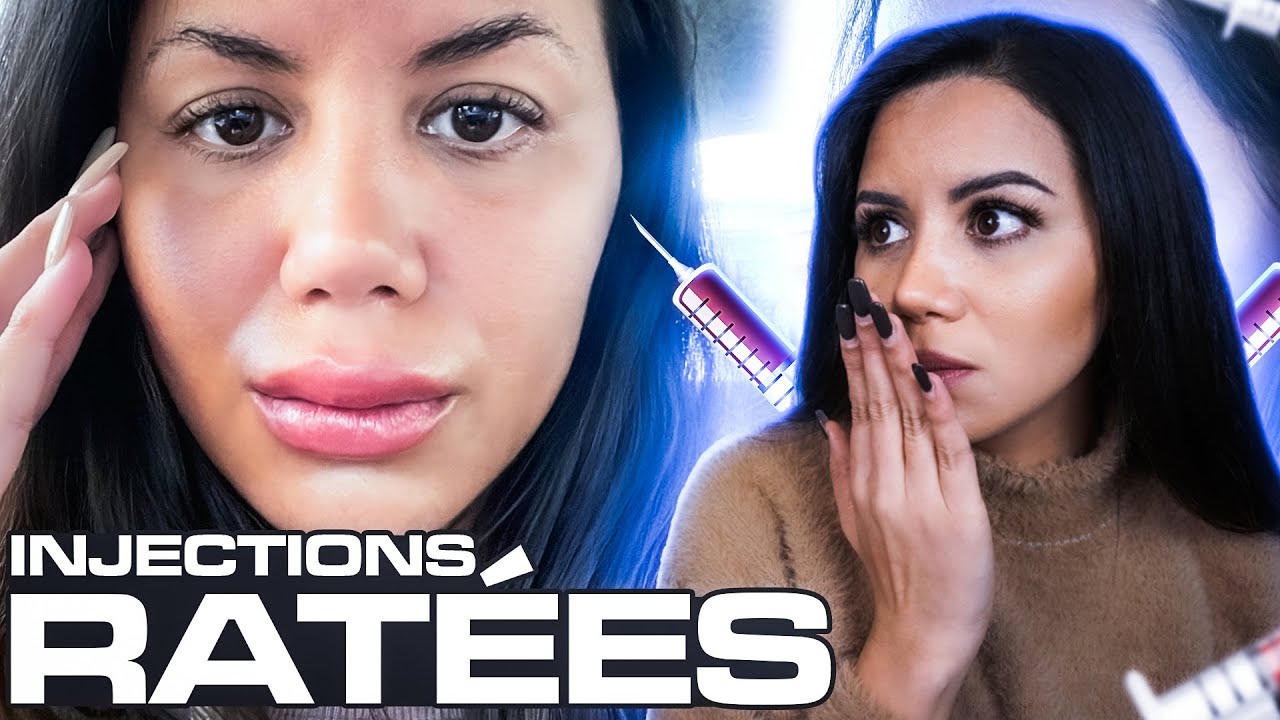 J'AI EU DES INJECTIONS AUX LÈVRES RATÉES 😭👄💉