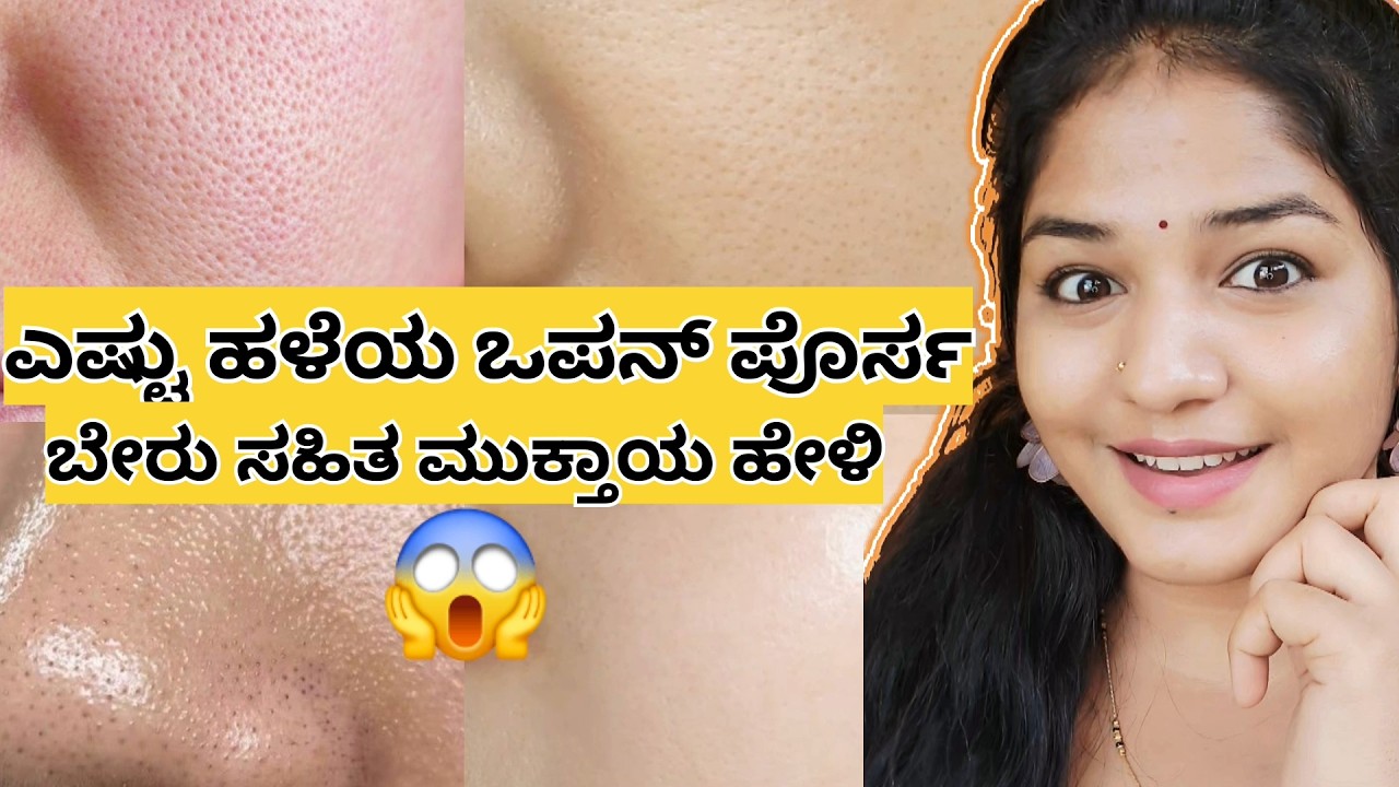 👀ನಿಮ್ಮ ಮುಖದ ಪೋರ್ಸ್ ದೊಡ್ಡದಾಗಿರೋದು ಈ ಒಂದು ಕಾರಣದಿಂದಾ? 😳ಸತ್ಯ ತಿಳ್ಕೊಳ್ಲೋ ಮುಂಚೆ ಇದನ್ನು ನೋಡಿ