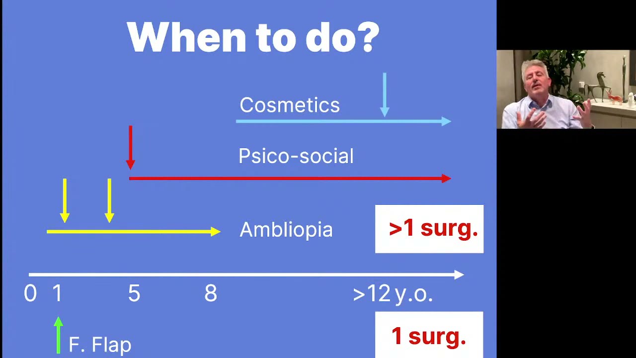 Ptosis palpebral o párpados caídos. Ptosis or drooping eyelids.