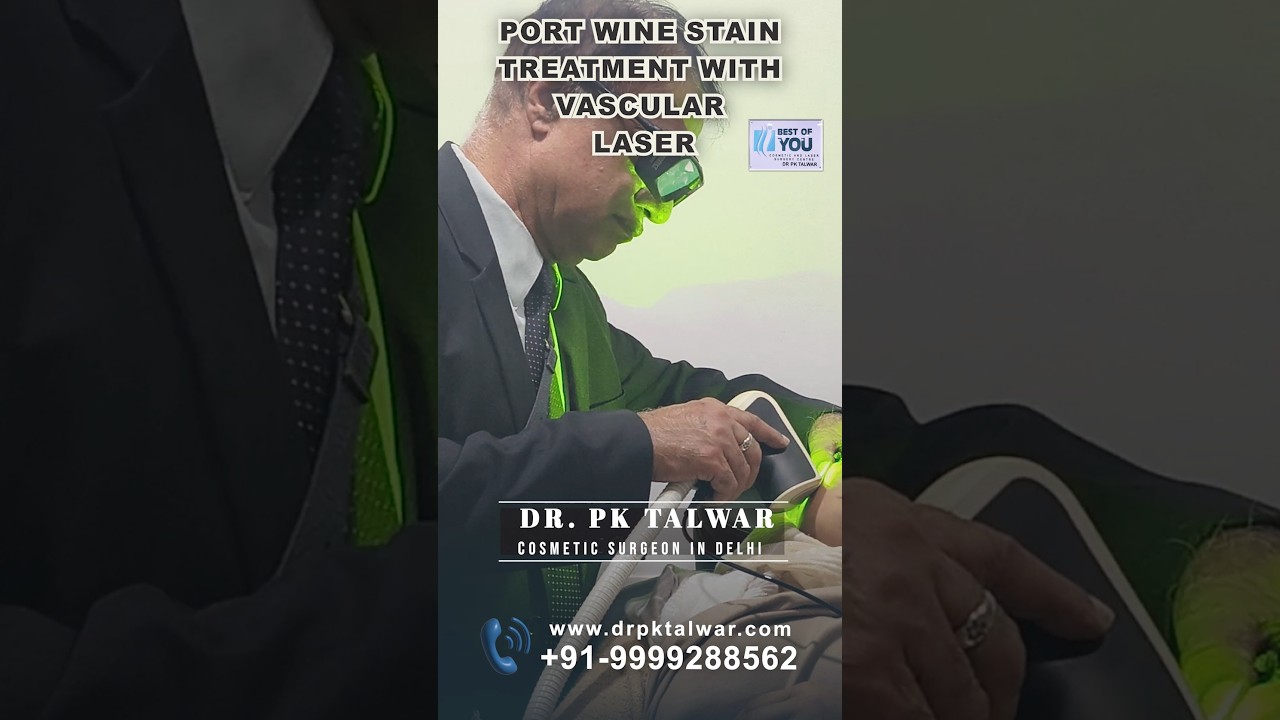 Port Wine Stain Treatment with Vascular Lasers | Port Wine Treatment in Delhi | Dr.PK Talwar