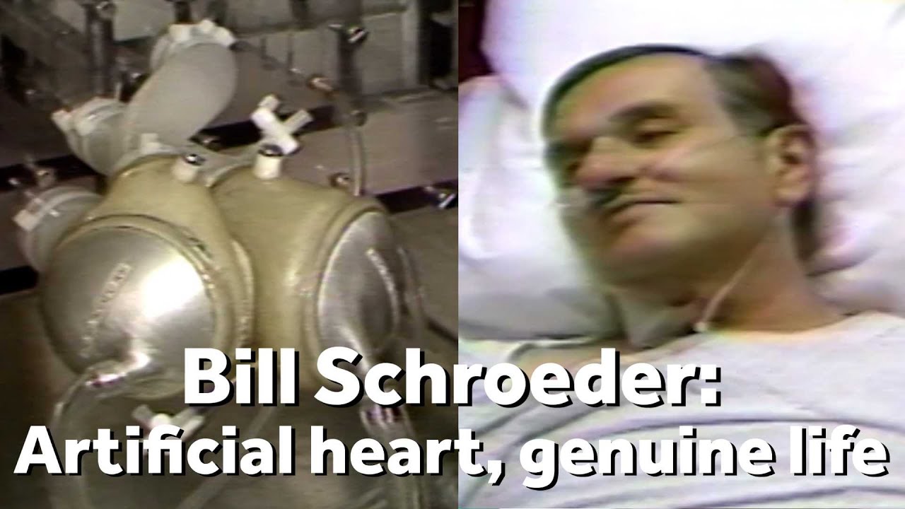 Bill Schroeder made medical history with artificial heart implant in &lsquo;80s