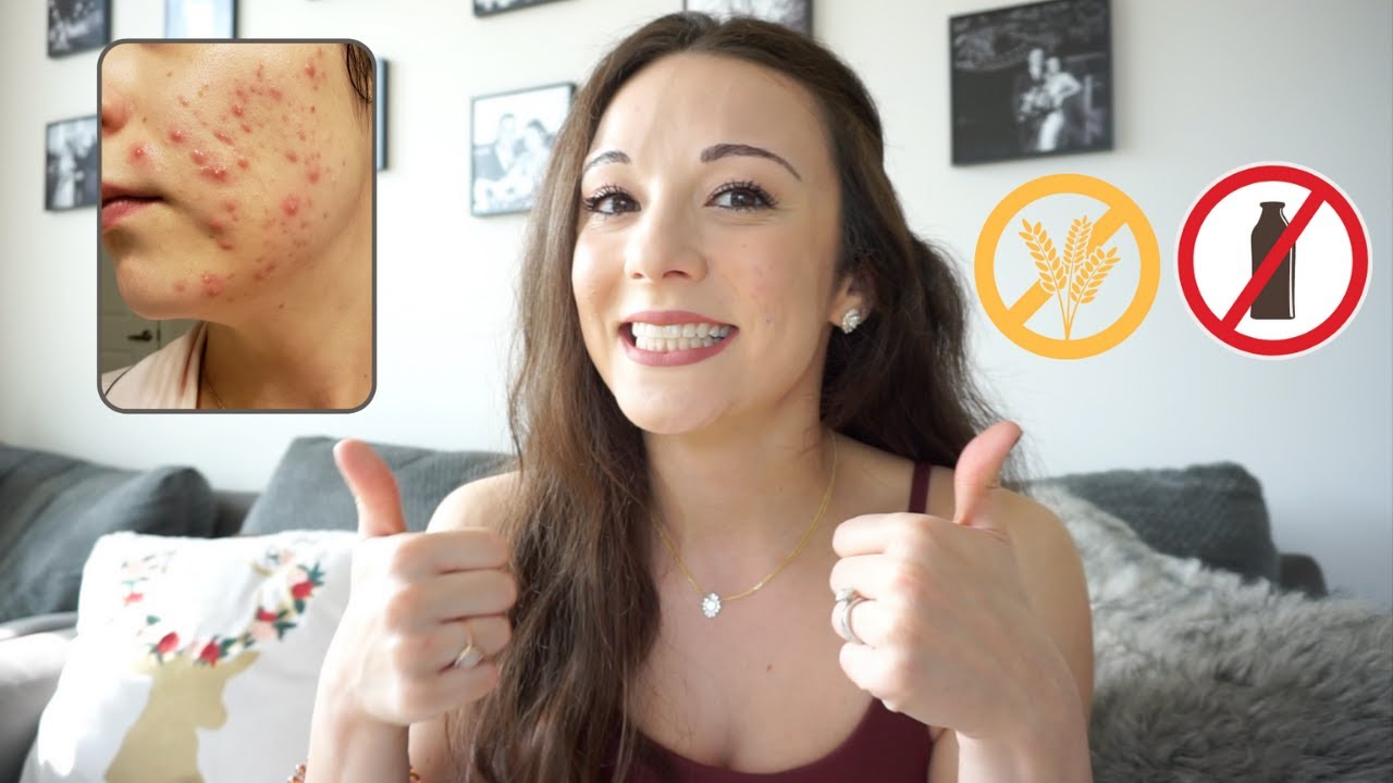 I Went GLUTEN & DAIRY-FREE for My Hormonal ACNE | Skin Update