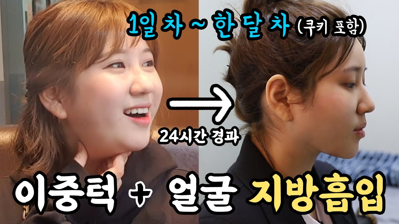 [얼굴지흡+이중턱] 단하루만에 얼굴 지방 찢었습니다 I 얼굴 지방흡입 전후 차이 쿠키영상포함 당일 애프터 전격공개!! 이 만큼 솔직한 변화는 없었다😁 [쀼]