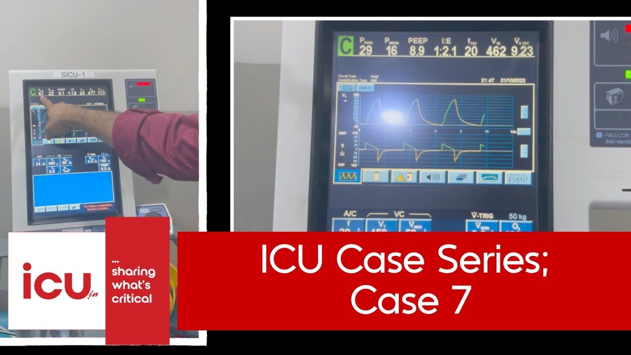 #icucase 7: ventilator mechanics, high peak pressures; but what's causing them??
