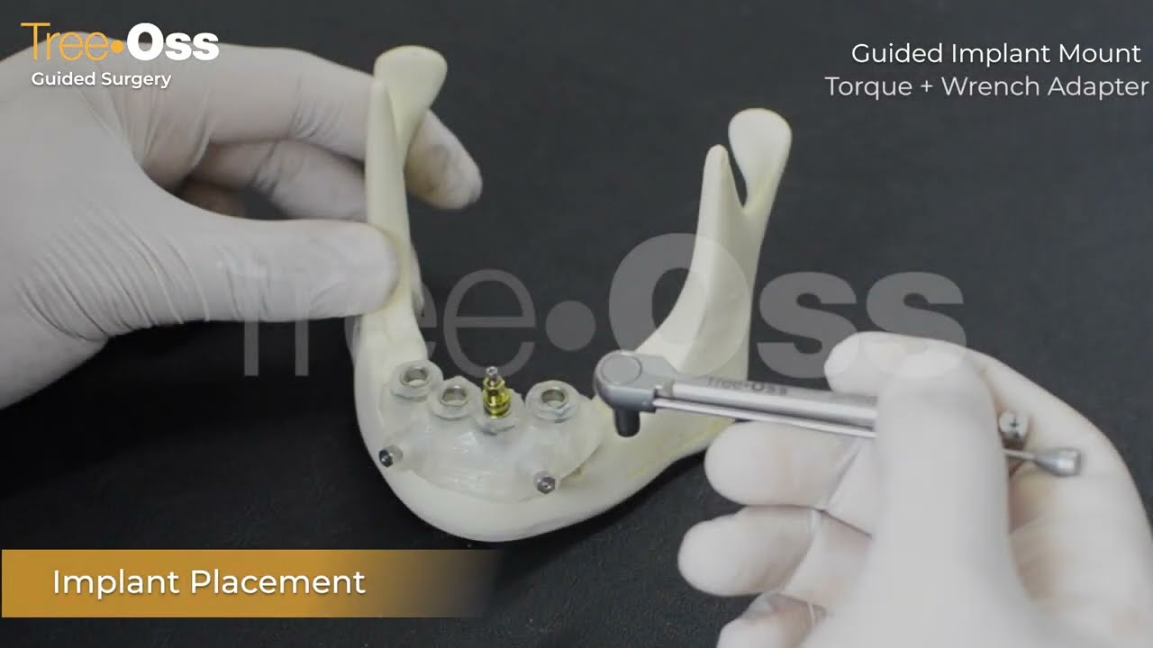 Tree•Oss® Guided kit Protocol / Protocolo Cirugía Guiada