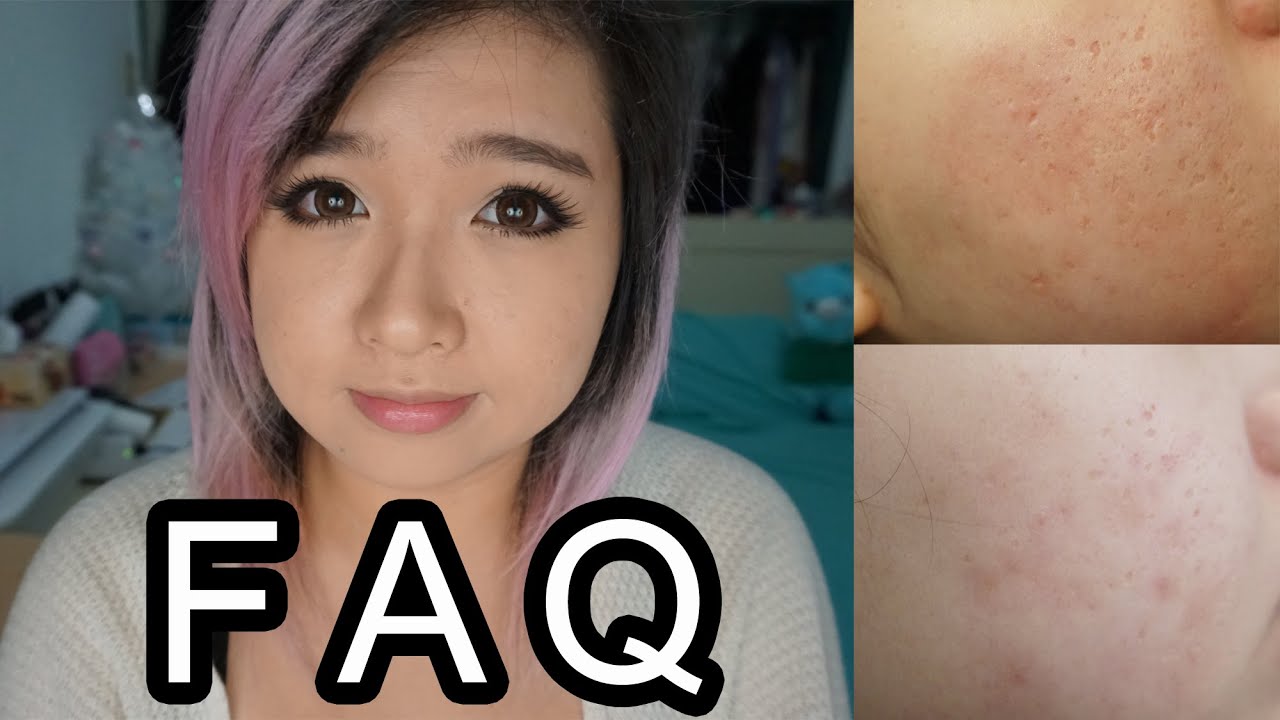 Banish Acne Scars FAQ + Giveaway ♥ Getting Rid of Acne Scars at Home!